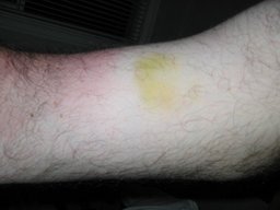 burn+bruise.jpg